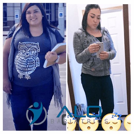 Before & After - Bariatric Surgery