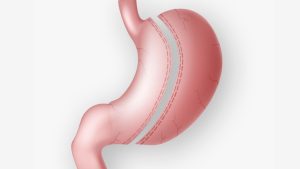 Can You Get Gastric Sleeve Surgery Twice if Things Go Sideways?