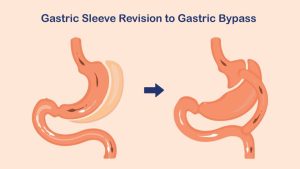 Gastric Sleeve Revision to Gastric Bypass the Right Option