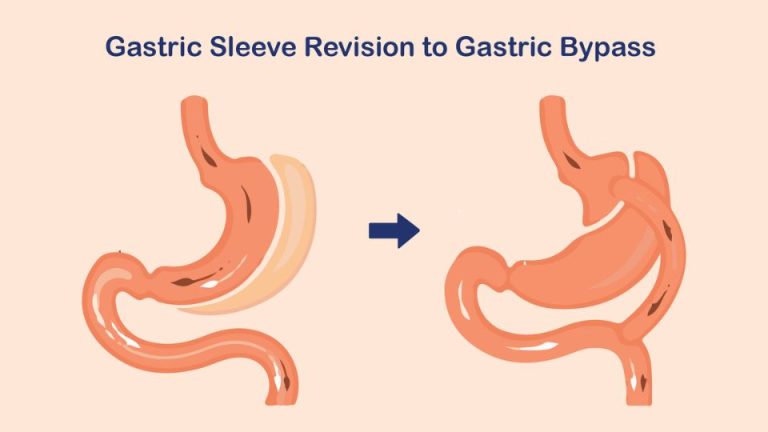 Gastric Sleeve Revision to Gastric Bypass: Is it A Right Option?