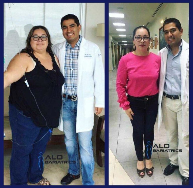 sadi-procedure-mexico-sadi-surgery