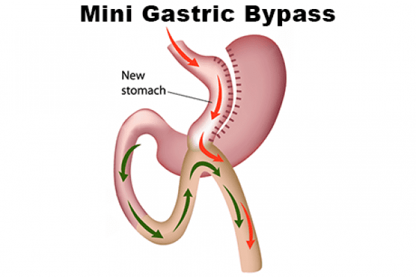 Diagram Illustrating Stomach After Mini Gastric Bypass Procedure